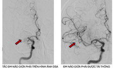 Bệnh viện Nhân dân 115 TP.HCM cứu thành công người Nga bị đột quỵ