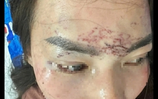 Khởi tố bị can vụ 'người phụ nữ bị bắt giữ, đánh đập, tạt axit vì ghen'