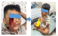 Đang chơi đùa, bé trai 5 tuổi bị chó cắn rách mặt