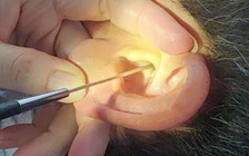 Nhiều người nhập viện tại TP.HCM do ngoáy tai