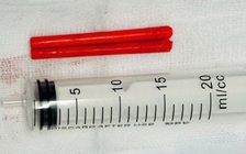 Say rượu ngã úp mặt, đôi đũa nhựa cắm mũi suốt một năm nhưng không biết