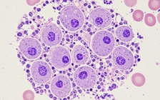 Nghiên cứu: Loại virus mới giúp điều trị ung thư chỉ sau 28 ngày