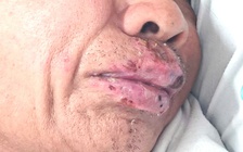 Bị điếc do nhiễm liên cầu heo khi thường xuyên ăn nem thịt sống, tiết canh