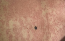 Nguy kịch vì dùng thuốc giảm cân, collagen 'xách tay'