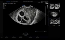 Theo dõi sức khỏe cho sản phụ mang 4 thai tự nhiên