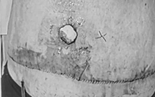 TP.HCM: Nữ bệnh nhân bị tai biến nặng sau hút mỡ bụng

