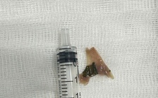 Quảng Ngãi: Nội soi gắp xương vịt sắc nhọn ở thực quản, cứu bé trai 12 tuổi