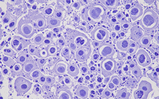 Nghiên cứu: Tìm ra cách điều trị hiệu quả ung thư gan, phổi và dạ dày