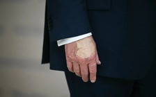 Dấu vết lạ trên mu bàn tay của Tổng thống Trump