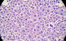 Vắc xin mới chống 2 loại ung thư nguy hiểm: Hiệu quả đầy hứa hẹn