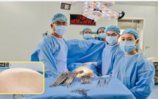 Khối u buồng trứng hơn 20 kg nhưng tưởng tăng cân