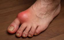 Bệnh gout ngày càng ‘trẻ hóa’ và nguy cơ tổn thương thận