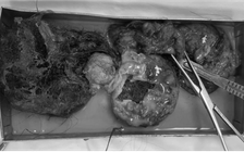 Cứu nữ bệnh nhân vỡ u quái buồng trứng, răng và tóc tràn ra ổ bụng