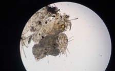 Ngứa mắt dai dẳng, cụ bà phát hiện rận mi