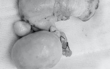 Tưởng chỉ chóng mặt do tăng huyết áp, ai ngờ rơi vào nguy kịch suýt chết