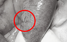 Cụ ông bị mảnh xương cá dài 4 cm cứa thủng ruột