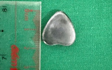 Trong lúc chơi đùa, bé trai 6 tuổi nuốt nam châm hình trái tim