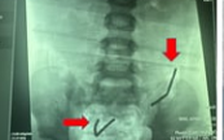 TP.HCM: Nuốt 20 viên nam châm, ruột non bé trai bị thủng 8 lỗ