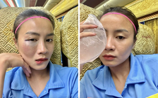‘Hot girl’ đội tuyển nữ Việt Nam chia sẻ khuôn mặt bầm tím vì thi đấu, fan xót xa