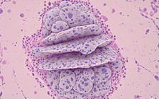 Nghiên cứu: Phát triển thành công phương pháp điều trị ung thư mới