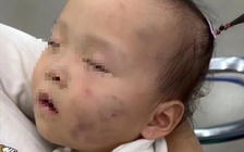 Tạm giữ bảo mẫu vụ bé gái 15 tháng tuổi có nhiều vết bầm tím