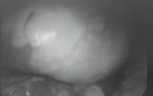 Đau bụng âm ỉ, nhập viện bác sĩ phát hiện khối u buồng trứng lớn