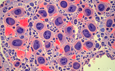 Nga: Vắc xin ung thư giảm 80% khối u chờ cấp phép sử dụng lâm sàng