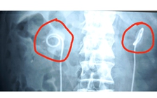 Sỏi bám đầy ống thông JJ sau 2 năm quên trong niệu quản