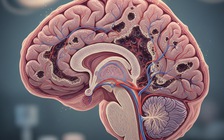 Nghiên cứu: Thuốc nhỏ mũi mới tiêu diệt hoàn toàn khối u chỉ sau 2 liều