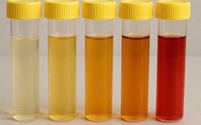 Màu nước tiểu cảnh báo thận đang gặp vấn đề