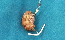 Vòng tránh thai 'đi lạc' vào bàng quang nhiều năm