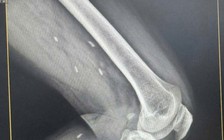 Kén sán rải rác trong vùng đùi và cẳng chân bệnh nhân