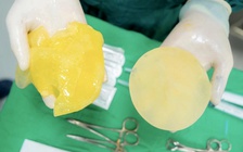 Túi nâng ngực có dễ vỡ khi chơi thể thao?