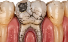 Vì sao thạch tín bị 'khai tử' ở nha khoa chính thống?