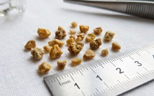 Không bỏ thói quen tưởng vô hại này, suy thận hồi nào không hay