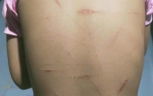 Vụ học sinh lớp 5 ở Cà Mau nghi bị bạo hành: Chưa đủ tuổi xử lý