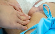 Đau bụng nhưng tự uống thuốc, người đàn ông bị thủng dạ dày, ngưng tim trên bàn mổ