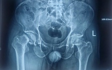 Phát hiện bị hoại tử xương sau nhiều năm chịu đựng cơn đau khớp háng
