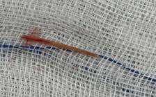 Đau bụng 5 ngày, đi khám phát hiện xương cá đâm xuyên ruột non