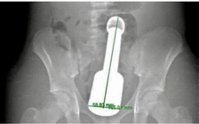 Chày kim loại kẹt trong trực tràng: Tuổi dậy thì và tâm lý 'một mình, thử xem sao'