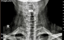 Sai lầm khi trị đau cổ vai gáy có thể gây liệt