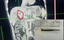 Hóc xương cá dài 3 cm xuyên vào đường mật... tưởng bị ung thư