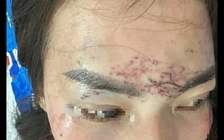 Đánh ghen, xăm lên mặt 'tình địch': 2 phụ nữ ở Cà Mau lãnh án tù