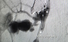 Cứu sống bệnh nhân ung thư chảy máu ồ ạt