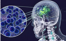 Cà Mau: 3 ca nghi viêm não mô cầu, 2 ca dương tính, 1 ca tử vong