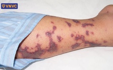 4 ca tử vong do bệnh não mô cầu, nguy cơ xuất hiện thêm các ca bệnh