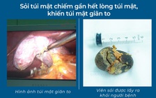 Phát hiện sỏi túi mật lớn gần bằng quả trứng gà khi khám sức khỏe định kỳ