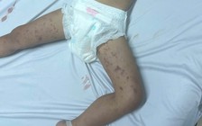 Xuất hiện viêm não mô cầu, Đắk Lắk khẩn trương truy vết người tiếp xúc