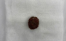 TP.HCM: Tin 'thuốc tan sỏi thận' trên mạng, người đàn ông tắc nghẽn đường niệu