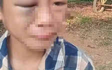 Xác minh vụ bé trai nghi bị mẹ kế và bố đánh đập